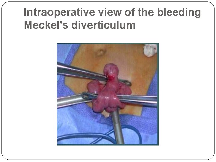 Intraoperative view of the bleeding Meckel's diverticulum 