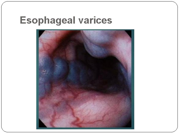 Esophageal varices 