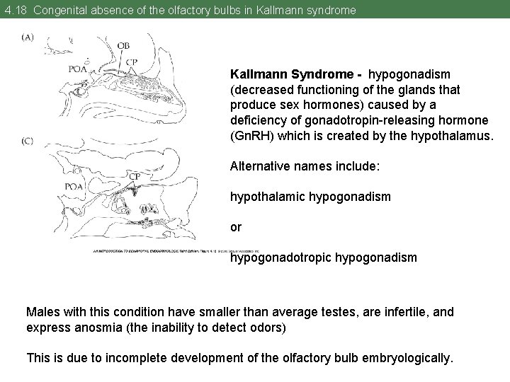 4. 18 Congenital absence of the olfactory bulbs in Kallmann syndrome Kallmann Syndrome -
