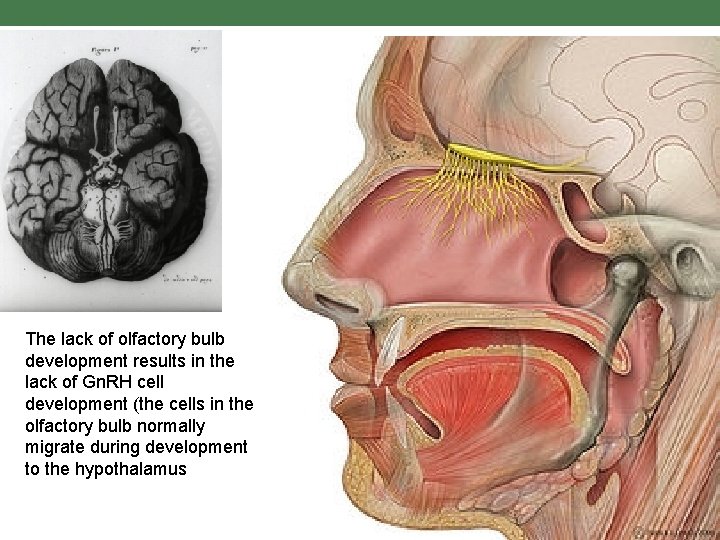 The lack of olfactory bulb development results in the lack of Gn. RH cell