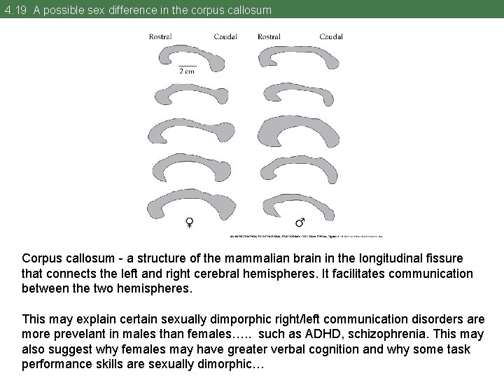 4. 19 A possible sex difference in the corpus callosum Corpus callosum - a