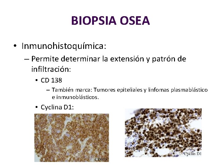 BIOPSIA OSEA • Inmunohistoquímica: – Permite determinar la extensión y patrón de infiltración: •
