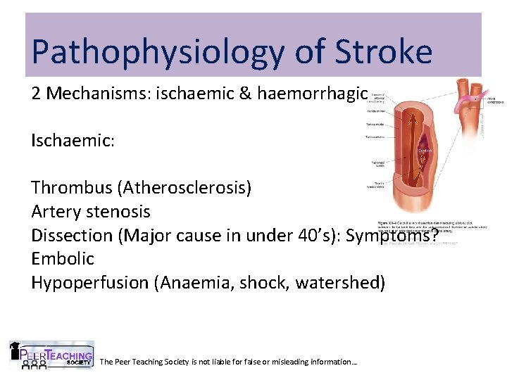 Pathophysiology of Stroke 2 Mechanisms: ischaemic & haemorrhagic Ischaemic: Thrombus (Atherosclerosis) Artery stenosis Dissection