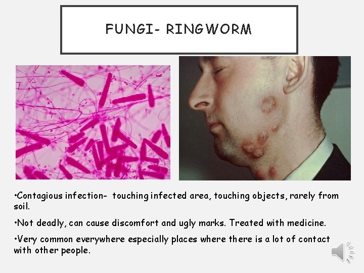 FUNGI- RINGWORM • Contagious infection- touching infected area, touching objects, rarely from soil. •