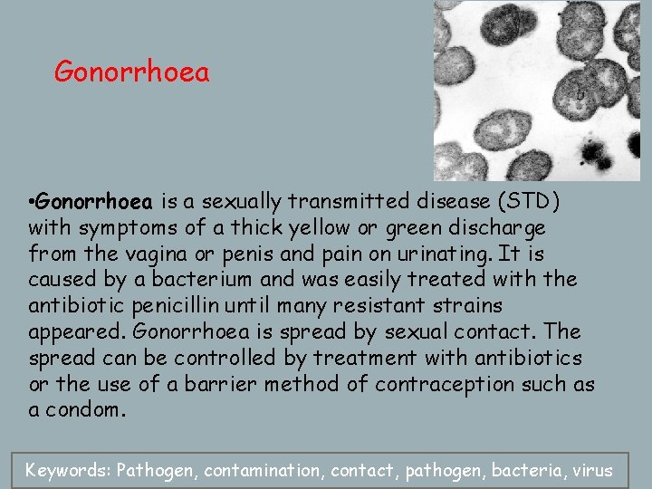 Gonorrhoea • Gonorrhoea is a sexually transmitted disease (STD) with symptoms of a thick
