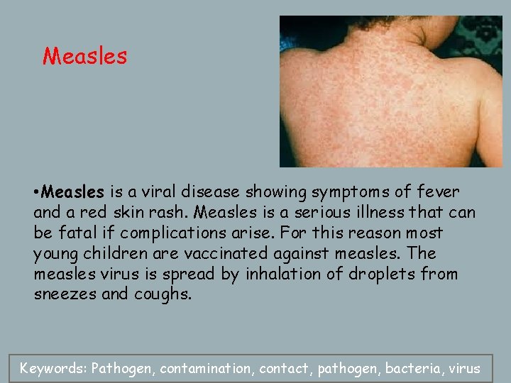 Measles • Measles is a viral disease showing symptoms of fever and a red