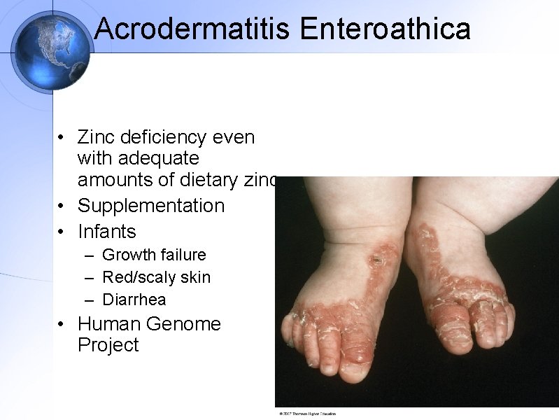 Acrodermatitis Enteroathica • Zinc deficiency even with adequate amounts of dietary zinc • Supplementation