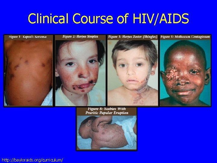 Clinical Course of HIV/AIDS http: //bayloraids. org/curriculum/ 