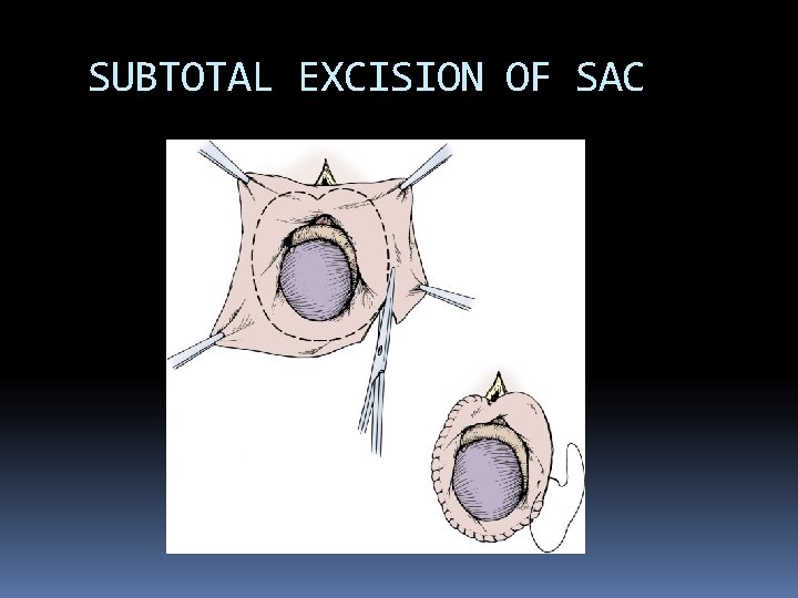 SUBTOTAL EXCISION OF SAC 