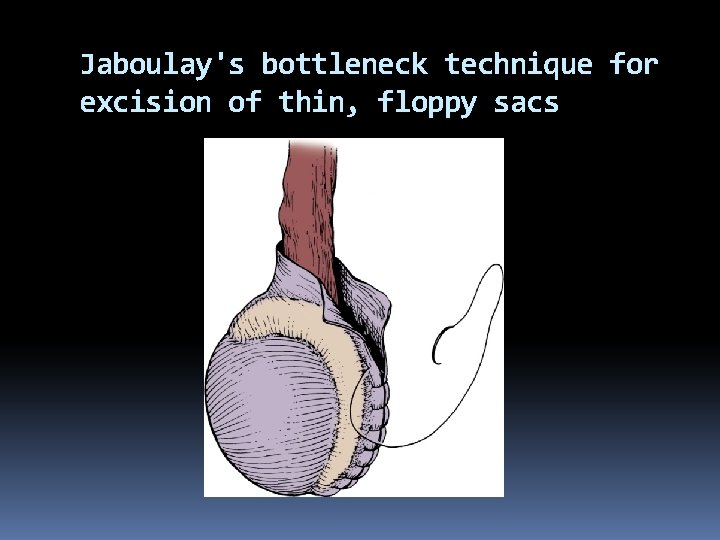 Jaboulay's bottleneck technique for excision of thin, floppy sacs 
