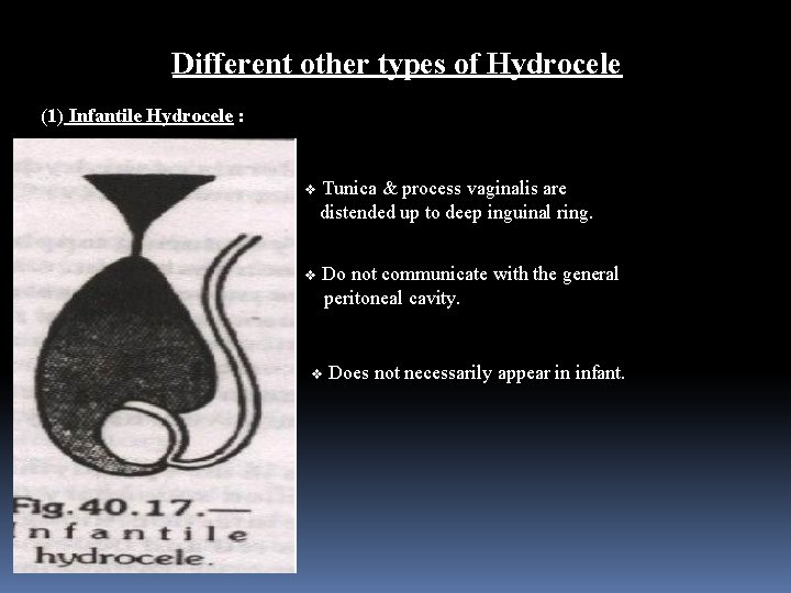 Different other types of Hydrocele (1) Infantile Hydrocele : v Tunica & process vaginalis