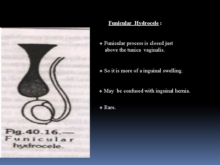 Funicular Hydrocele : v Funicular process is closed just above the tunica vaginalis. v