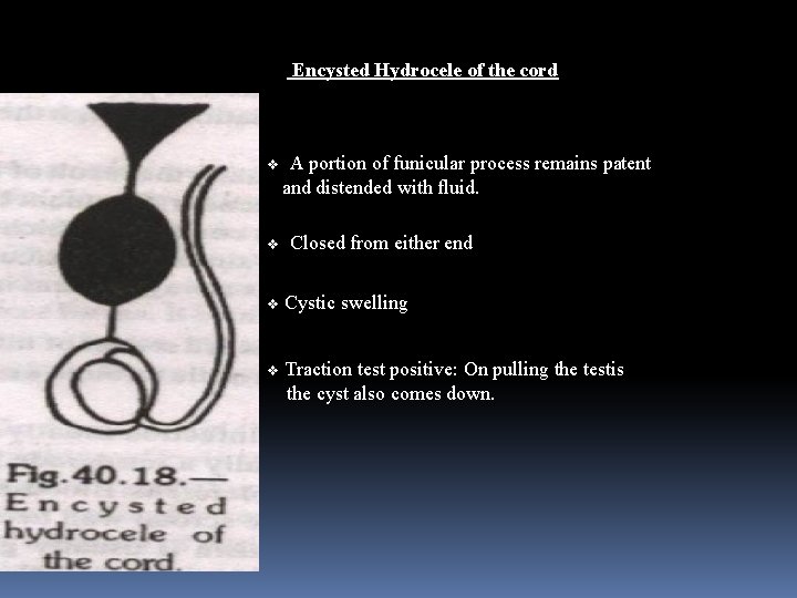 Encysted Hydrocele of the cord v v A portion of funicular process remains patent