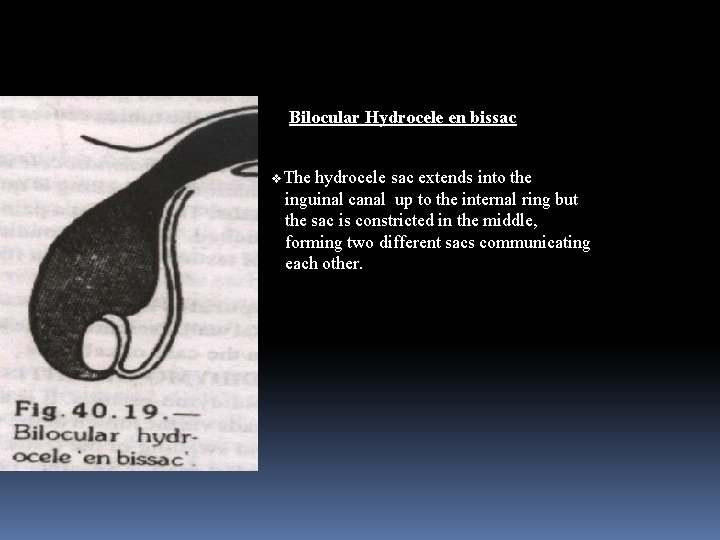 Bilocular Hydrocele en bissac v. The hydrocele sac extends into the inguinal canal up