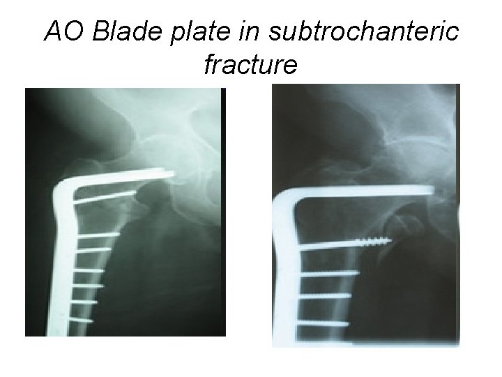 AO Blade plate in subtrochanteric fracture 