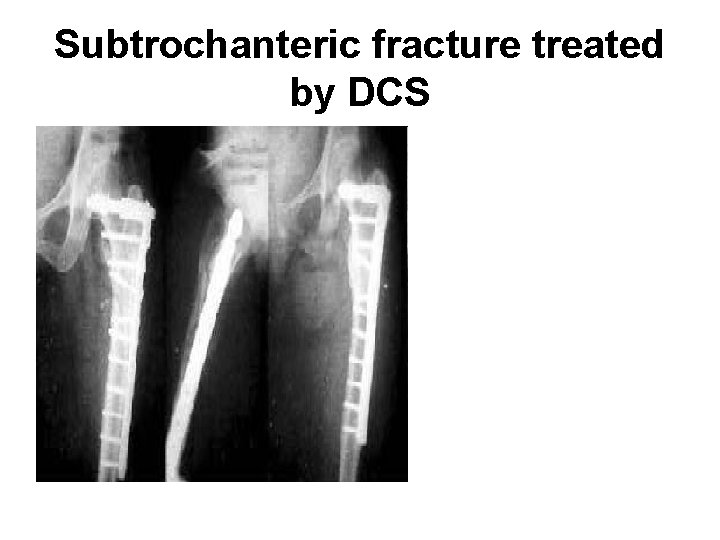 Subtrochanteric fracture treated by DCS 