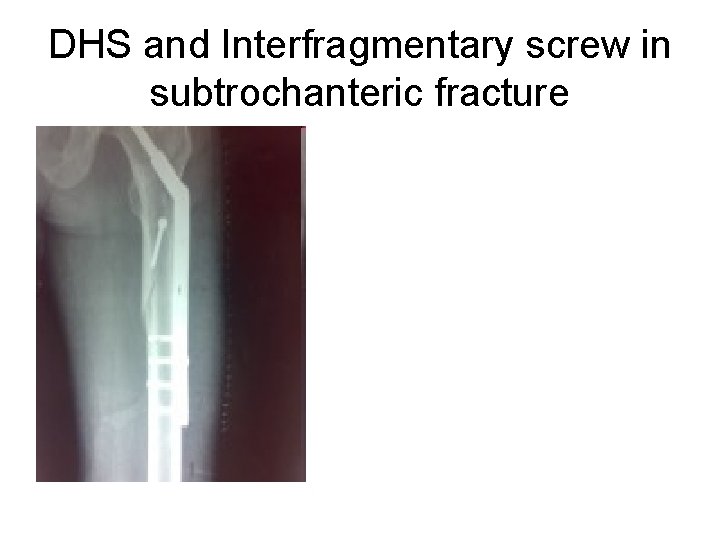 DHS and Interfragmentary screw in subtrochanteric fracture 