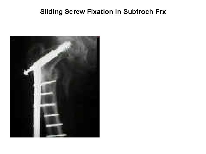 Sliding Screw Fixation in Subtroch Frx 