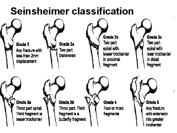 Seinsheimer classification 