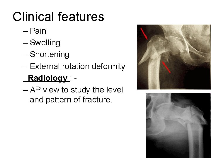 Clinical features – Pain – Swelling – Shortening – External rotation deformity Radiology :