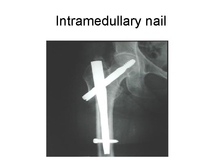 Intramedullary nail 