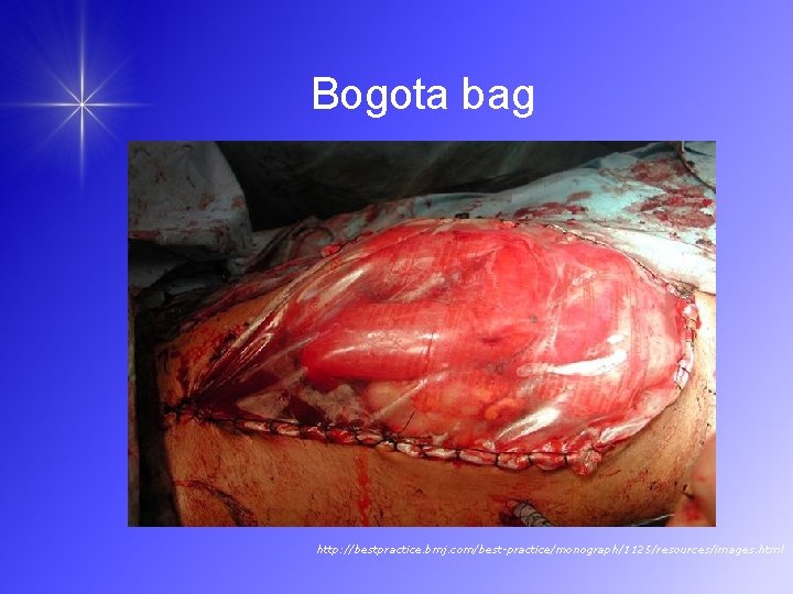 Bogota bag http: //bestpractice. bmj. com/best-practice/monograph/1125/resources/images. html 