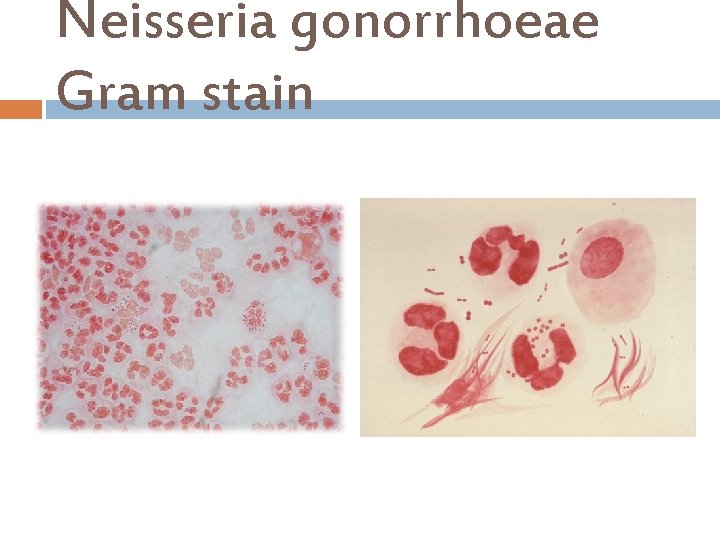 Neisseria gonorrhoeae Gram stain 