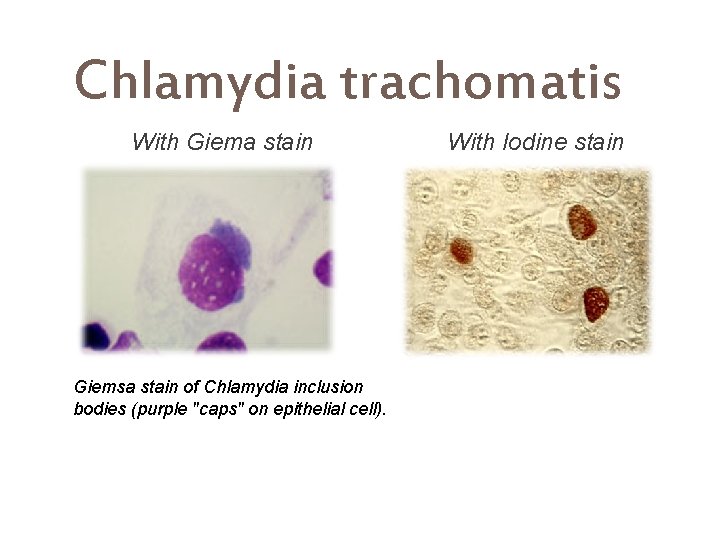 Chlamydia trachomatis With Giema stain Giemsa stain of Chlamydia inclusion bodies (purple "caps" on