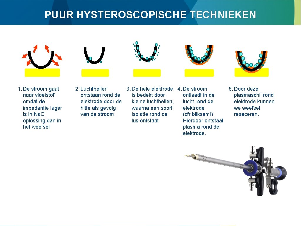 PUUR HYSTEROSCOPISCHE TECHNIEKEN 1. De stroom gaat naar vloeistof omdat de impedantie lager is