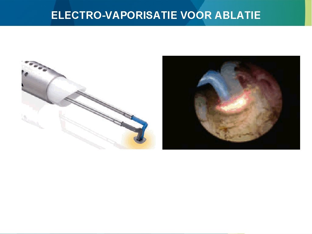 ELECTRO-VAPORISATIE VOOR ABLATIE 