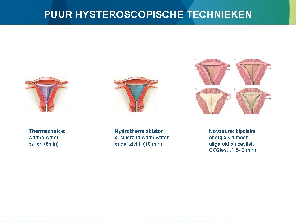 PUUR HYSTEROSCOPISCHE TECHNIEKEN Thermachoice: warme water ballon (8 min) Hydrotherm ablator: circulerend warm water