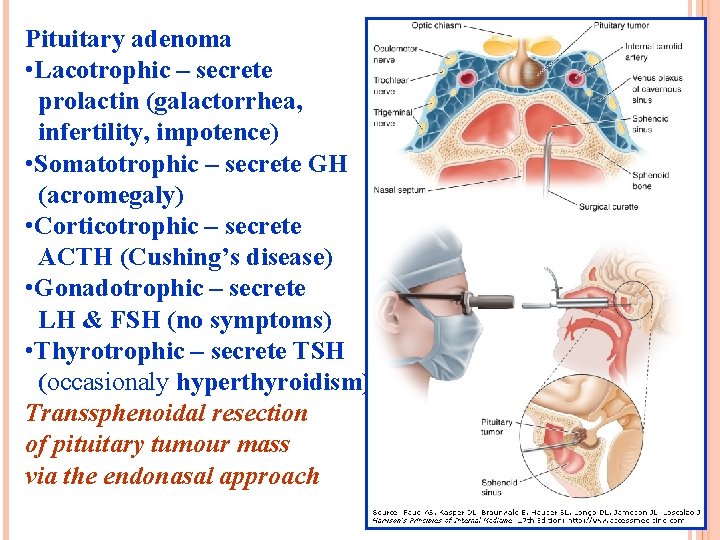 Pituitary adenoma • Lacotrophic – secrete prolactin (galactorrhea, infertility, impotence) • Somatotrophic – secrete