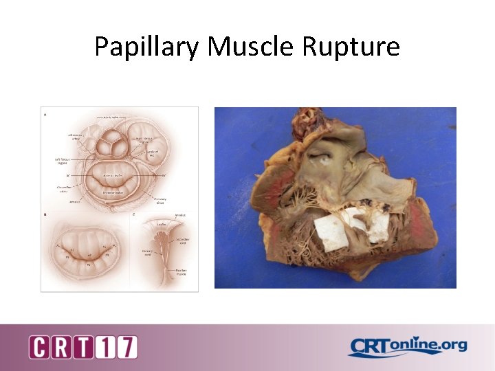 Papillary Muscle Rupture 