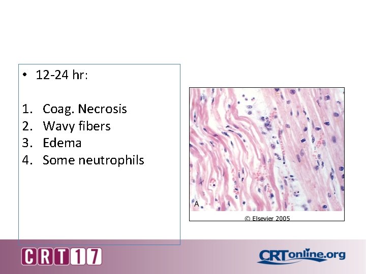  • 12 -24 hr: 1. 2. 3. 4. Coag. Necrosis Wavy fibers Edema