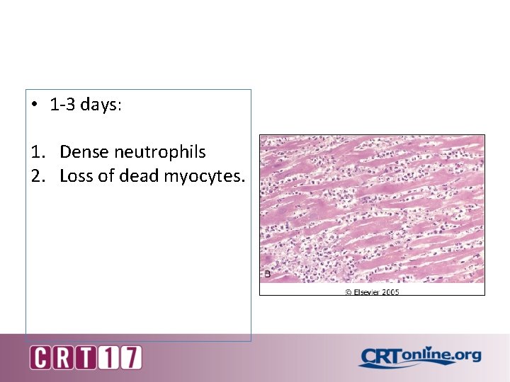  • 1 -3 days: 1. Dense neutrophils 2. Loss of dead myocytes. 