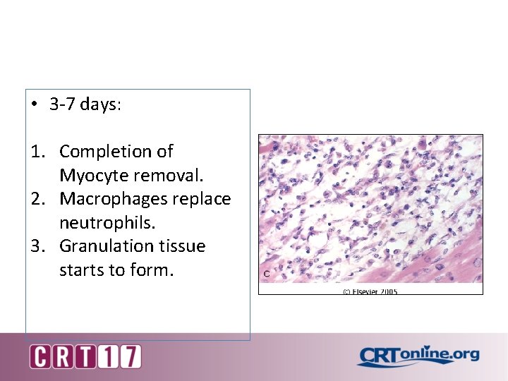  • 3 -7 days: 1. Completion of Myocyte removal. 2. Macrophages replace neutrophils.
