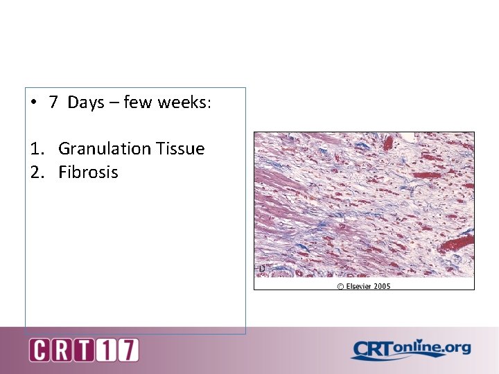  • 7 Days – few weeks: 1. Granulation Tissue 2. Fibrosis 