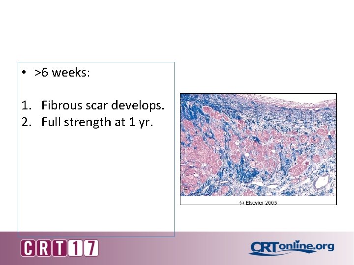  • >6 weeks: 1. Fibrous scar develops. 2. Full strength at 1 yr.