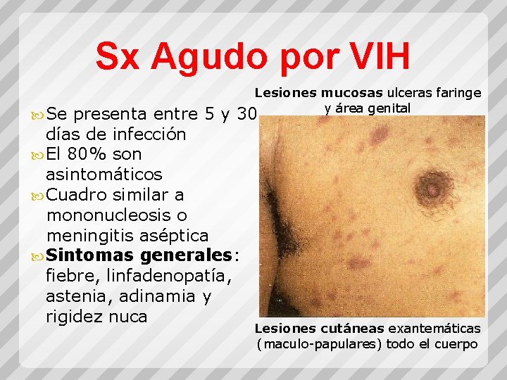 Sx Agudo por VIH Se Lesiones mucosas ulceras faringe y área genital presenta entre