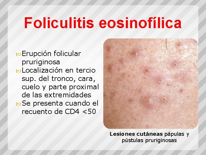 Foliculitis eosinofílica Erupción folicular pruriginosa Localización en tercio sup. del tronco, cara, cuelo y