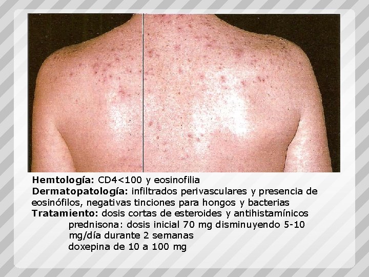 Hemtología: CD 4<100 y eosinofilia Dermatopatología: infiltrados perivasculares y presencia de eosinófilos, negativas tinciones