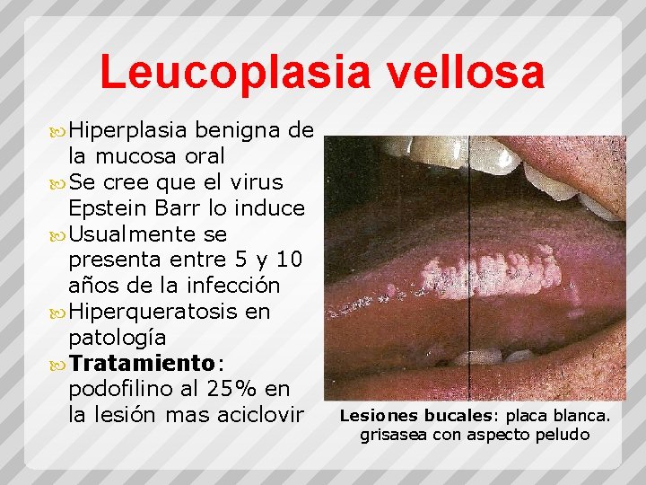 Leucoplasia vellosa Hiperplasia benigna de la mucosa oral Se cree que el virus Epstein