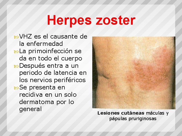 Herpes zoster VHZ es el causante de la enfermedad La primoinfección se da en