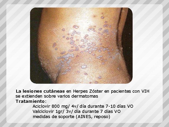 La lesiones cutáneas en Herpes Zóster en pacientes con VIH se extienden sobre varios