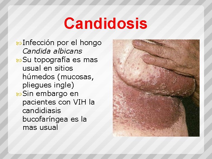 Candidosis Infección por el hongo Candida albicans Su topografía es mas usual en sitios