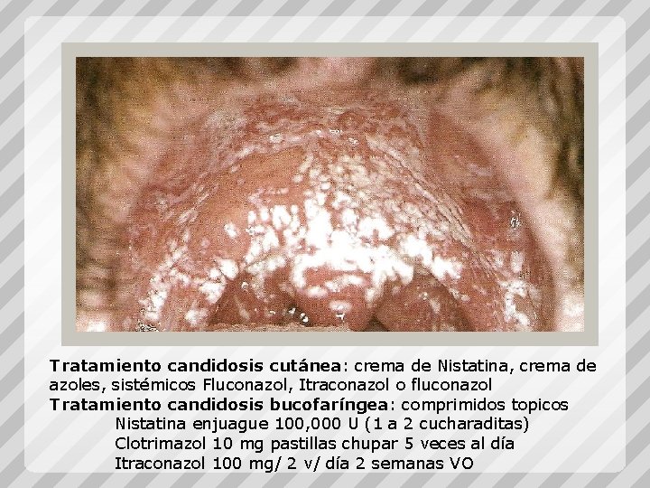 Tratamiento candidosis cutánea: crema de Nistatina, crema de azoles, sistémicos Fluconazol, Itraconazol o fluconazol