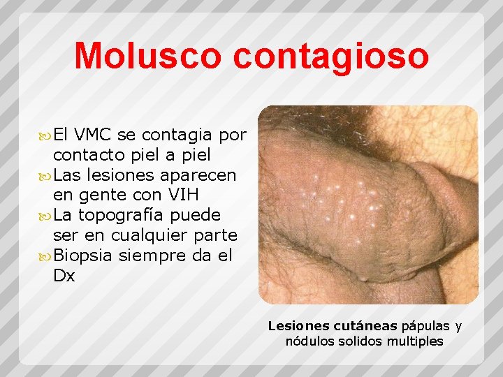 Molusco contagioso El VMC se contagia por contacto piel a piel Las lesiones aparecen