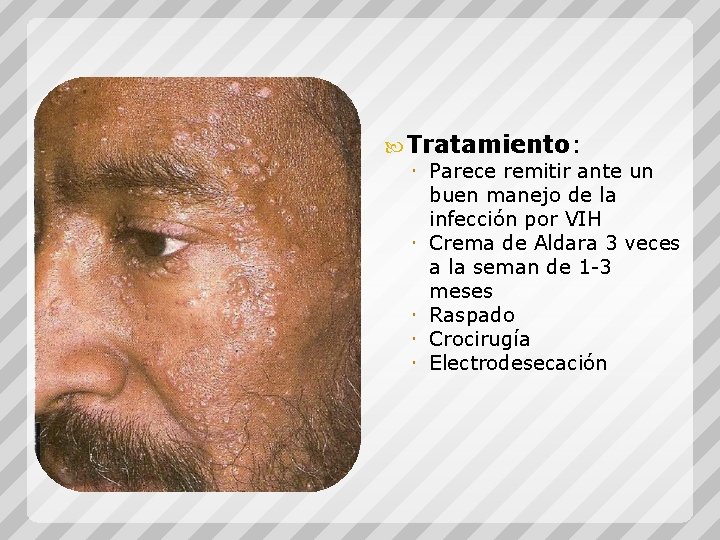  Tratamiento: Parece remitir ante un buen manejo de la infección por VIH Crema