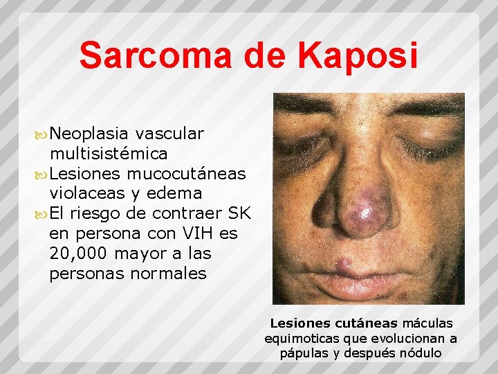 Sarcoma de Kaposi Neoplasia vascular multisistémica Lesiones mucocutáneas violaceas y edema El riesgo de