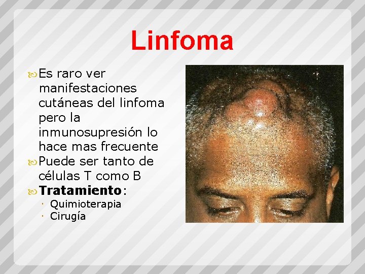 Linfoma Es raro ver manifestaciones cutáneas del linfoma pero la inmunosupresión lo hace mas